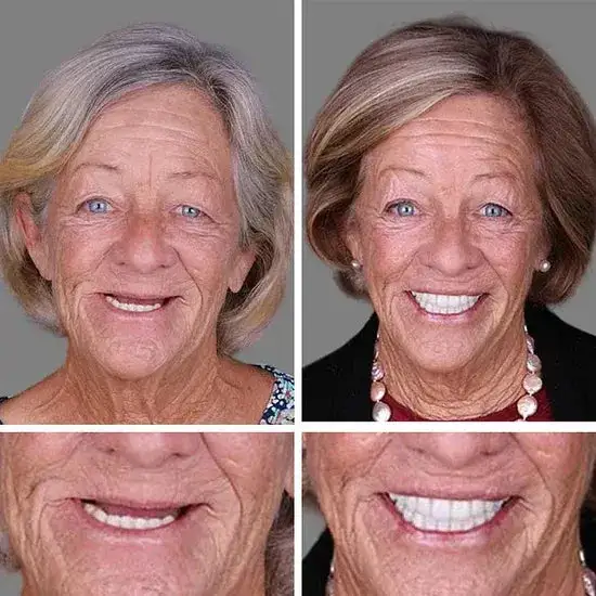 Custom-Fit Dentures— Designed for Comfort and a Natural-Looking Smile - Image 9